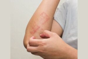 The impact of stress on Psoriasis