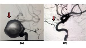 A-giant-35-cm-aneurysm-A-treated-with-Flow-Divertor-Stenting-has-disappeared-on-a-6-month-follow-up-angiogram-B