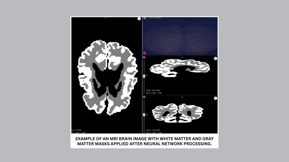 Example of an MRI brain image with white matter and gray matter masks applied after neural network processing. - PNN - Yandex